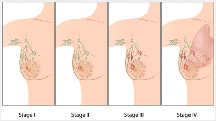 Breast Cancer