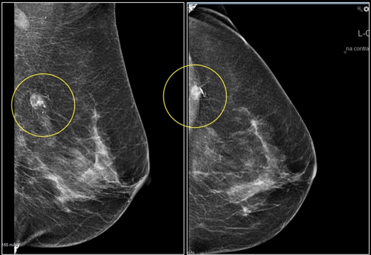 Molybdenum target mammography