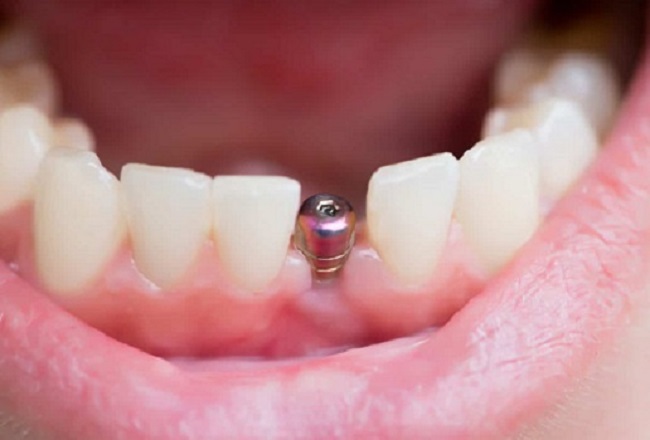 Titanium dental implant