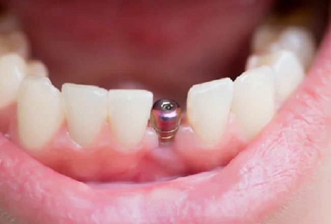 titanium dental implant