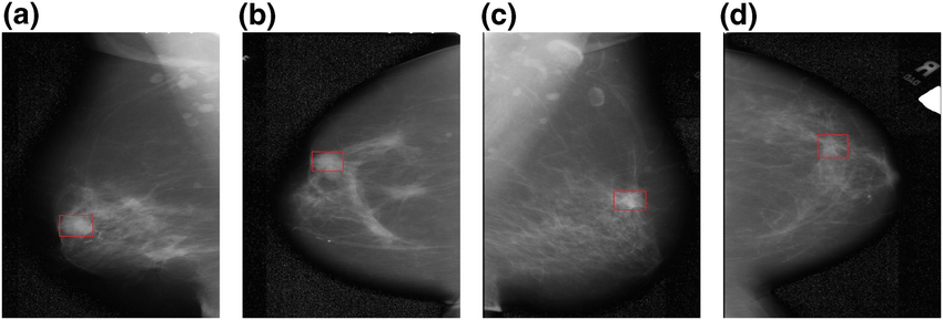 Molybdenum target mammograms of a patient.
